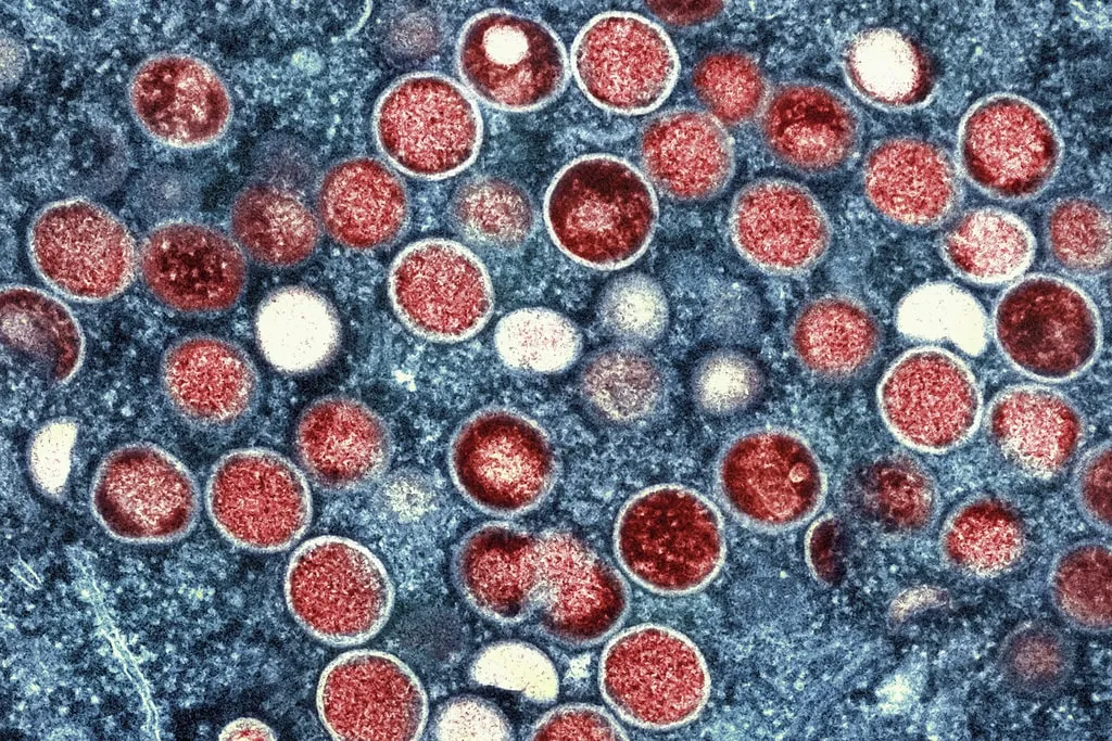 Mpox is Down, but US Cities could be at Risk for Summertime Outbreaks